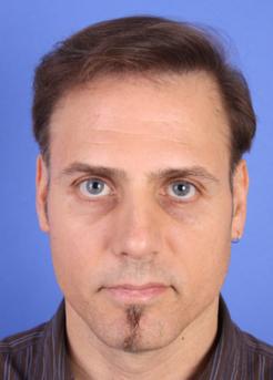 After Hair Transplant&nbsp;Revision
